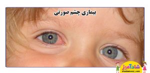 ورم چشم یا چشم صورتی کودک